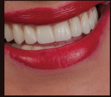 Caso clínico con zirconia DentalStock