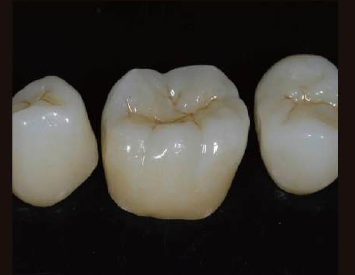 Caso clínico con zirconia DentalStock
