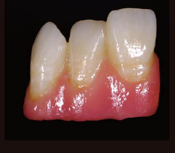 Caso clínico con zirconia DentalStock