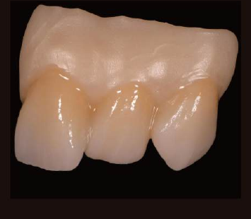 Caso clínico con zirconia DentalStock